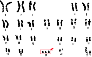 21トリソミー染色体のカリオタイプ